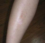 腿部白斑不同发病阶段的症状
